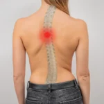 Escoliosis en San Martin Texmelucan
